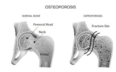 OSTEOPOROSIS & HA