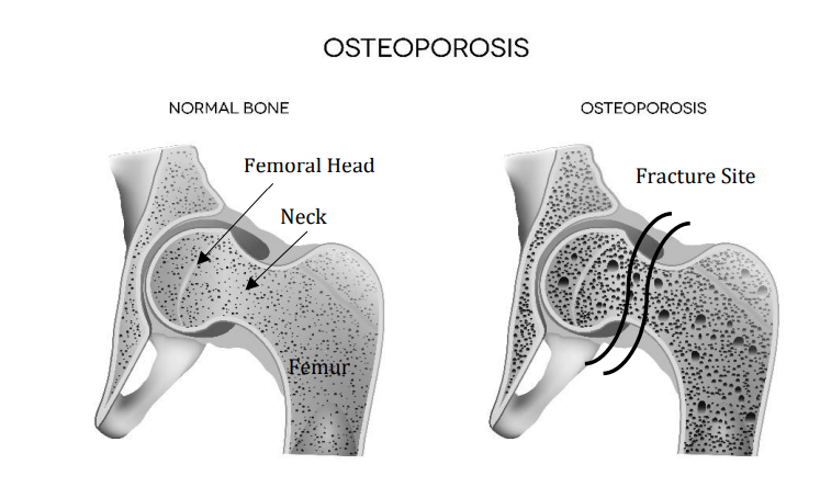 Osteoporosis Diagram